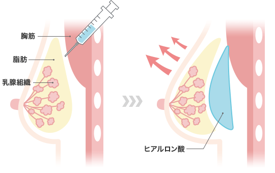 ヒアルロン酸注入による豊胸