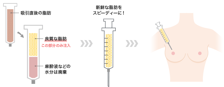 脂肪注入による豊胸