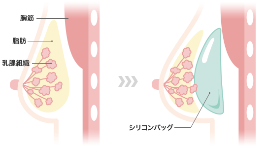 シリコンバッグ豊胸の図解