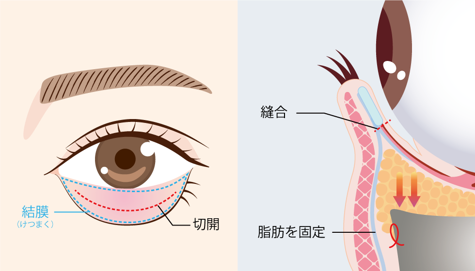 切開のイメージ図