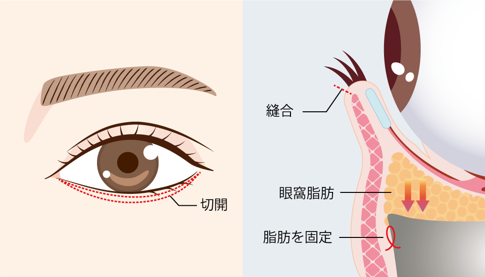 ハムラ法