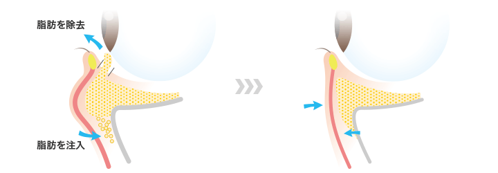 下眼瞼脱脂の図